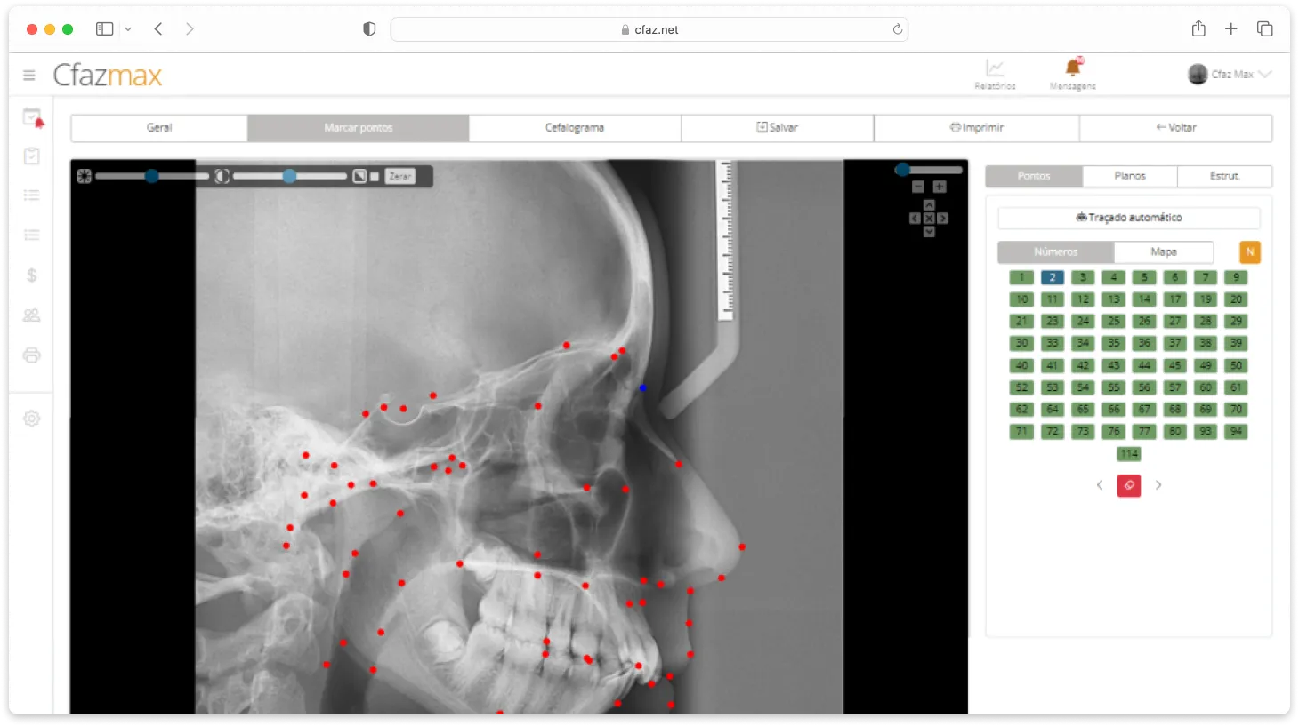 Pantalla del sistema Cfaz.net con un examen de cefalometría